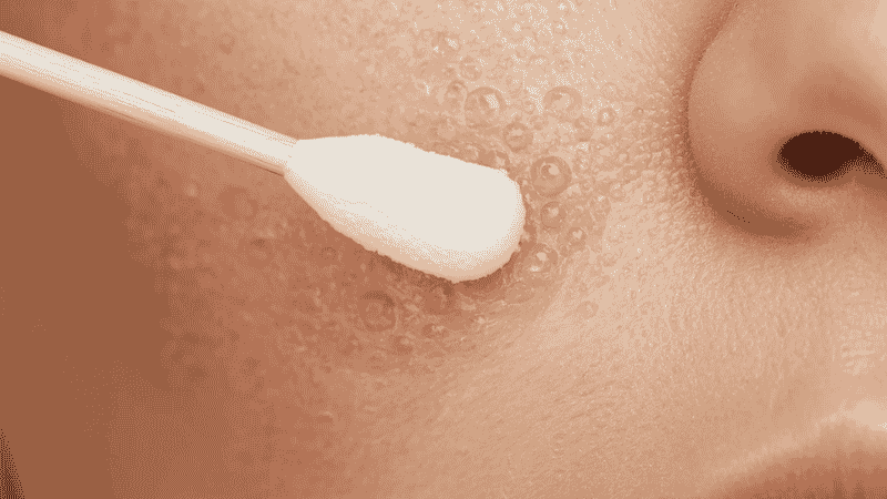 Small amount of benzoyl peroxide spot treatment applied directly onto an active pimple