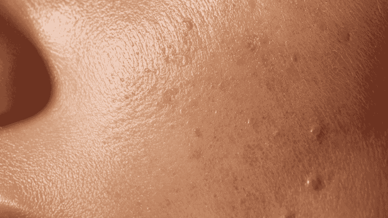 Close-up of dry flaky skin texture on cheek showing tightness and rough patches needing hydration