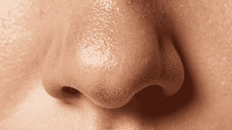 Close-up of skin showing clogged pores and blackheads on nose area explaining what causes breakouts