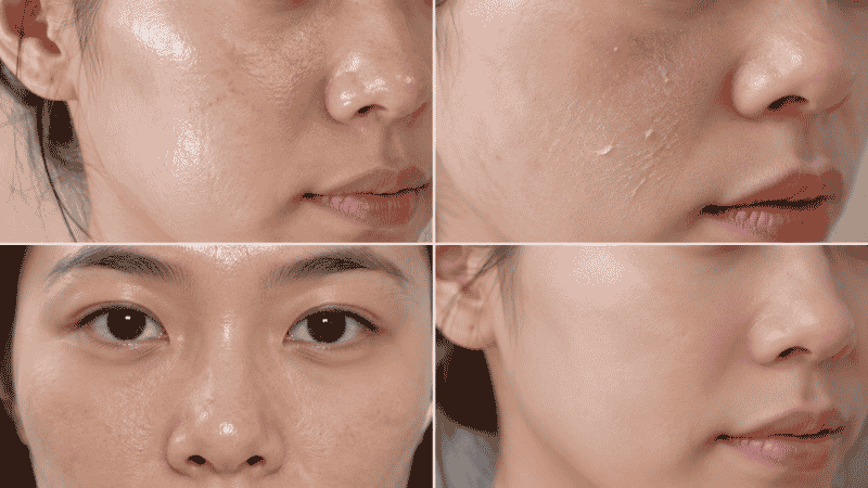 Four close-up skin texture examples showing oily shiny skin dry flaky skin combination T-zone and normal balanced skin