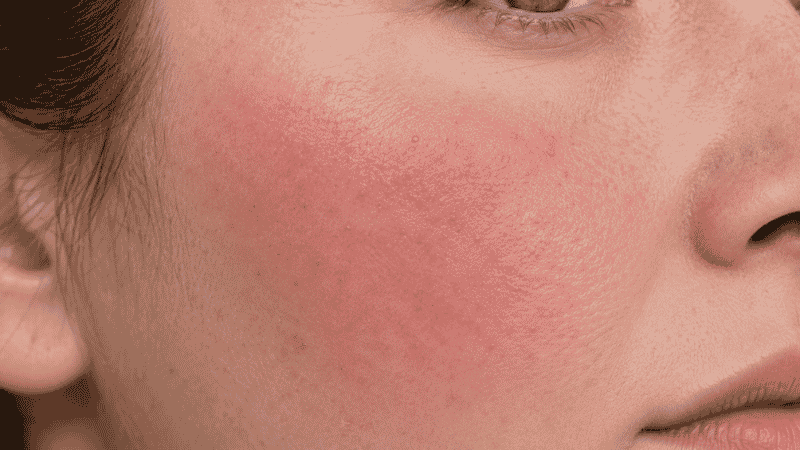 Close-up of reddened irritated skin on a cheek showing a mild cosmetic reaction with slight redness and flushing